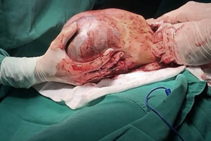 Em fenômeno raro, Pará registra nascimento de gêmeo dentro da bolsa amniótica da mãe